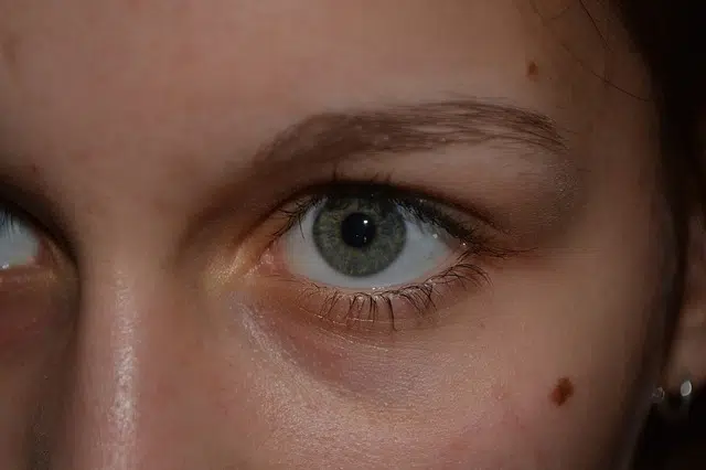 Birthmarks